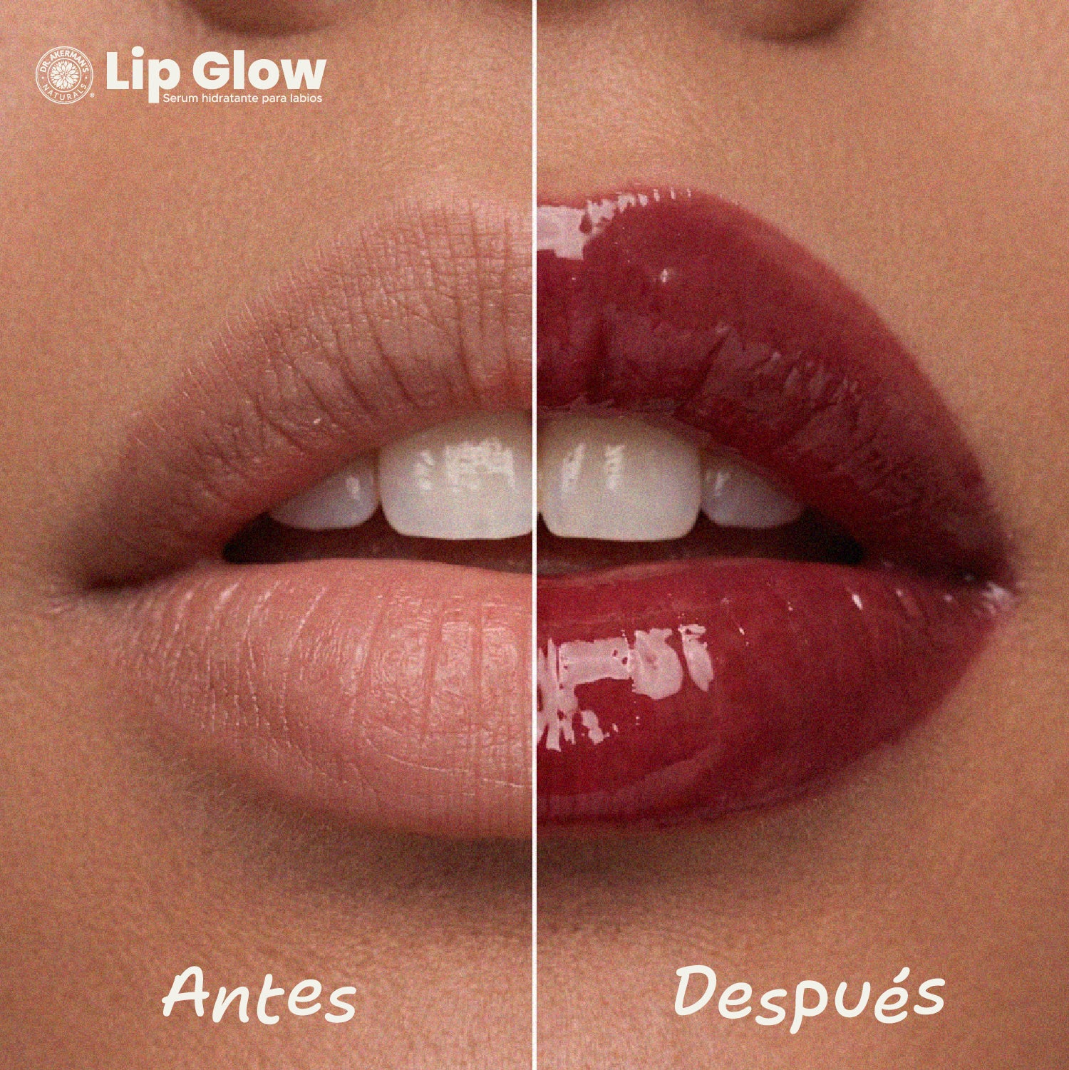 Lip Glow Serum Cherry Soda Dr Akerman´s Ultra Hidratante Filler Progresivo No pegajoso